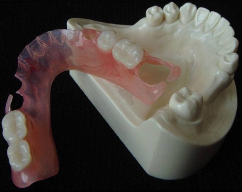 Unilateral Flexible Partial Denture Code