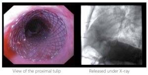 Covered Esophageal Stents