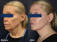 What recovery from CO2 laser resurfacing procedure looks like?