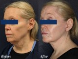 What recovery from CO2 laser resurfacing procedure looks like?