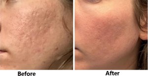 CO2 Fractional Laser Resurfacing Restores Your Skin