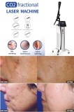 CO2 Fractional Laser Skin Resurfacing removes the top layers of skin tissue