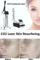 The Complete Guide To CO2 Laser Skin Resurfacing