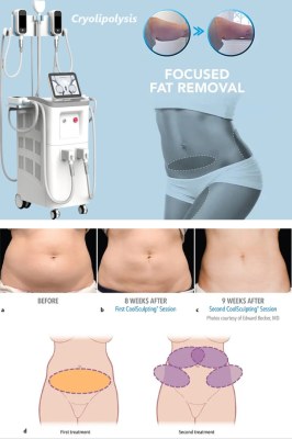 The precautions for cryolipolysis treatment