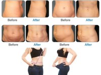 Cryolipolysis: Nonsurgical Fat Reduction