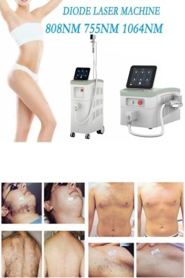 The High Power Diode Laser: A Comprehensive Guide to Aesthetic Treatments