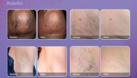 What Are the Benefits of Medical Grade Diode Laser Hair Removal Treatment?