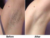 Safe and affordable permanent laser hair removal