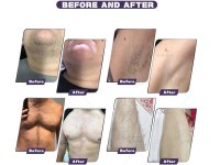 The diode laser hair removal experience