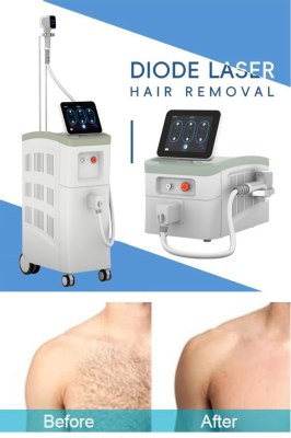 A Comprehensive Diode Laser Hair Removal Guide: Expert Insights & Top Tips