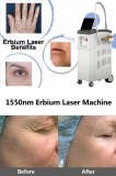 Good Candidate for Erbium Laser Resurfacing