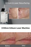 Erbium laser resurfacing treatment