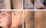 Understanding Skin Concerns Addressed by Picosecond Laser Treatment