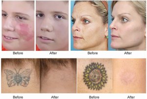 Advanced Picosecond laser tattoo removal, faster and better results