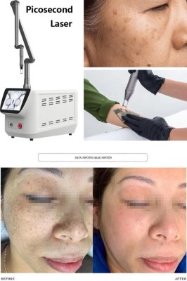 Picosecond Laser vs. Q-Switched Laser for Pigmentation Treatment